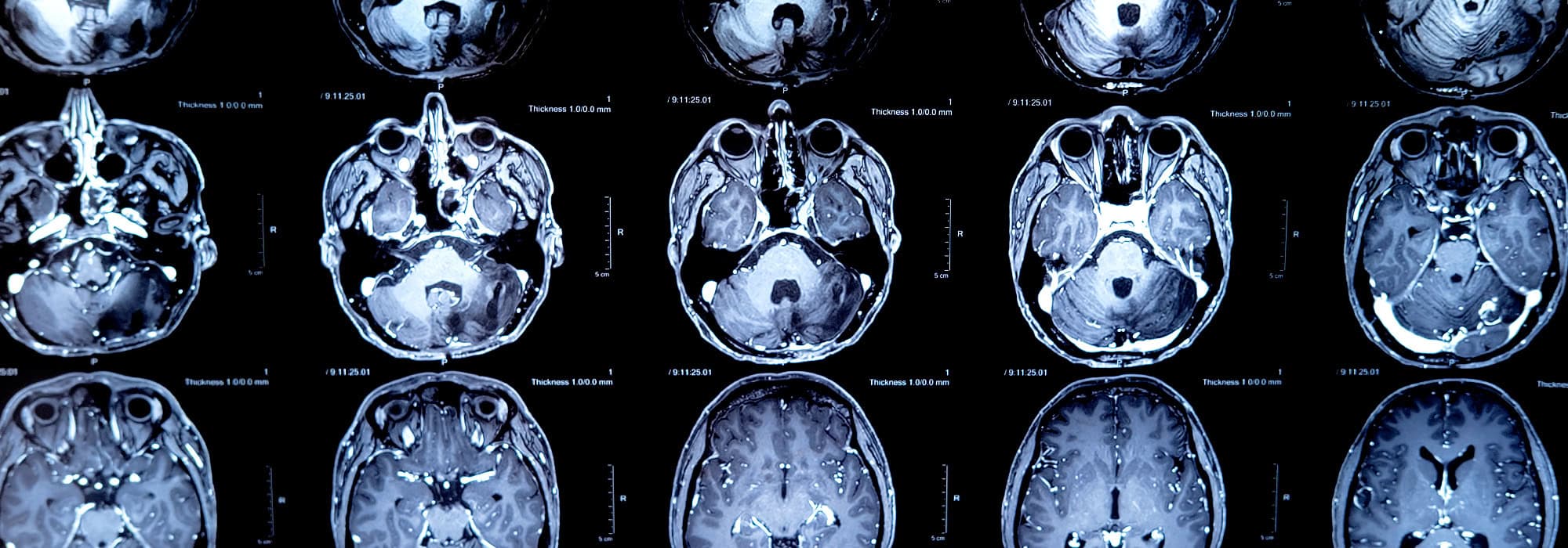 Mri brain scan with tumor
