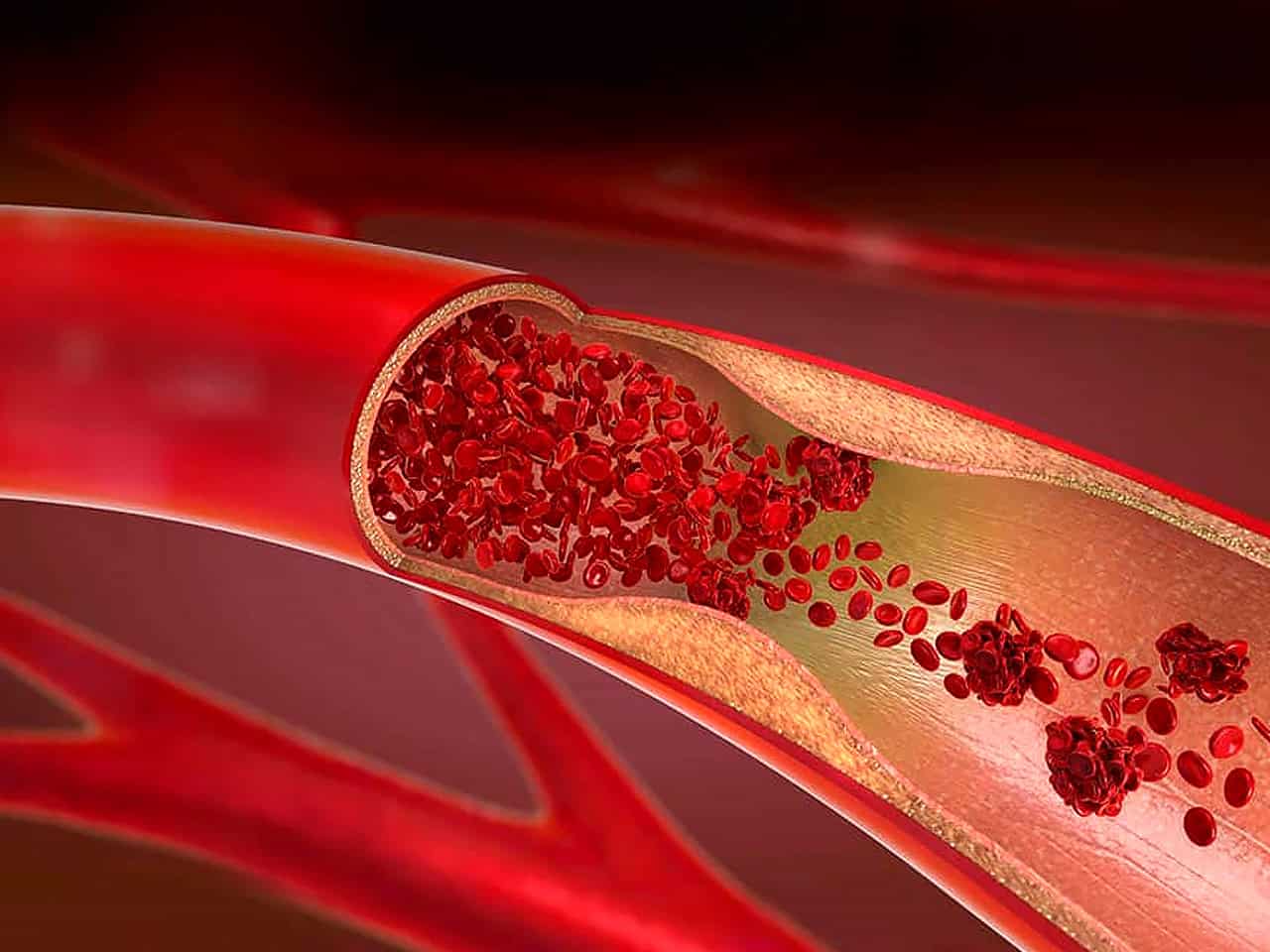 Blood vessel closeup showing blockage